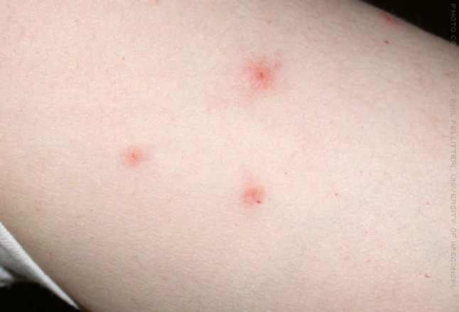 bed bug bites: picture of what bed bug bites look like