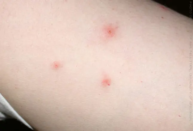 Bedbug bites on person's arm