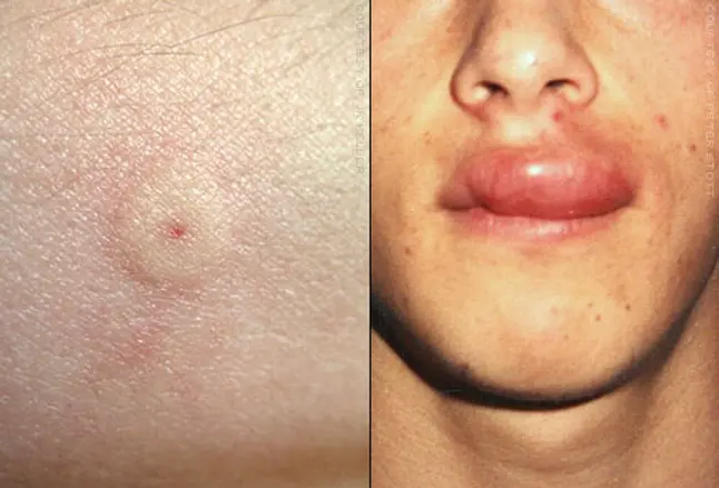 Details of wasp sting and swollen upper lip
