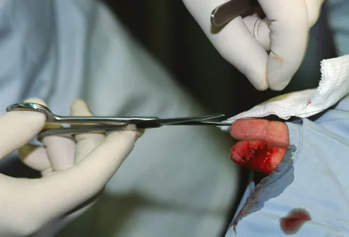 Doctor Putting Stitches into Finger Wound
