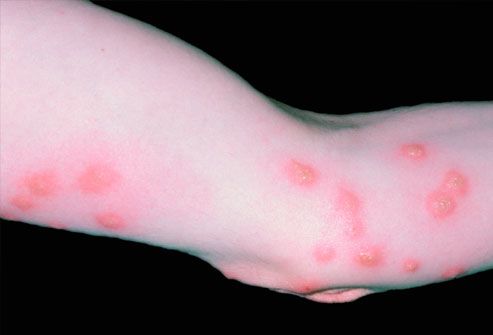 Infected bedbug bites on arm
