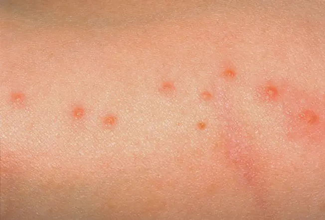 Signs and Symptoms of Bedbug Bites