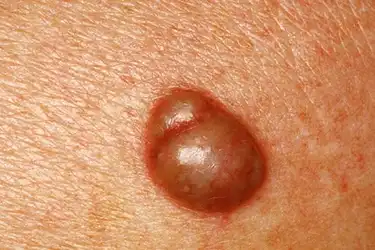 Small white spots on anus