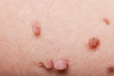 Head spots on little of penis red Spots on