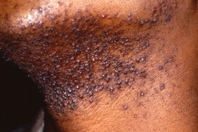 photo of shaving bumps