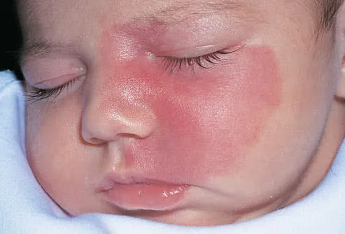 Port-wine stain on infants face