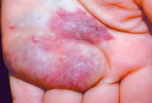 venous malformation on the hand