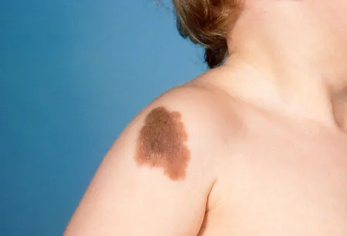 pigmented hairy mole on the child's shoulder