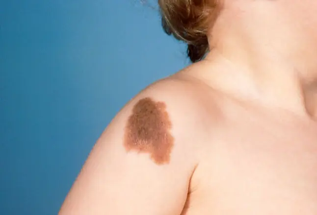 pigmented hairy mole on the child's shoulder