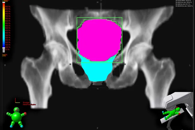 photo of pelvic radiotherapy