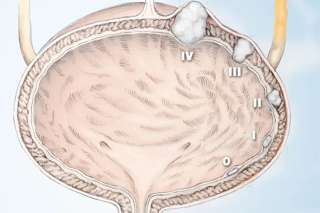 illustration of bladder cancer_stages