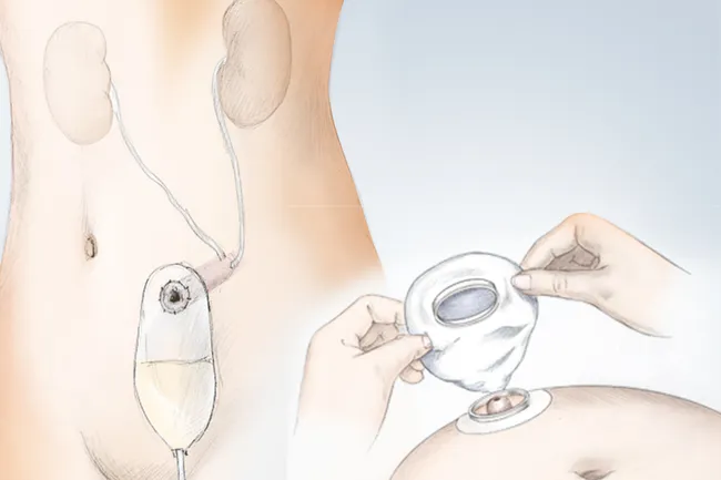 illustration of bladder catheter