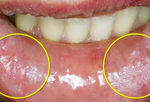 skin damage on inside of lower lip