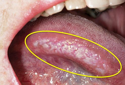 damage on side of tongue