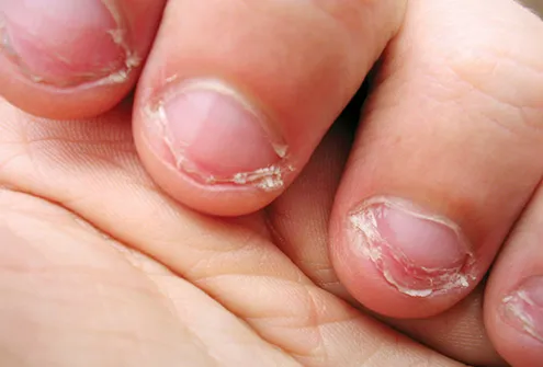 chewed fingernails