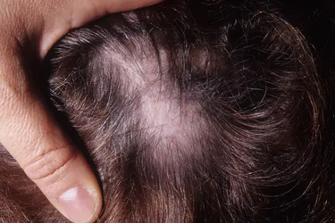 Alopecia com cicatrizes