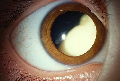retinoblastoma in child's eye