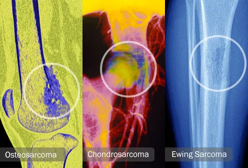 Visual Guide To Bone Cancer