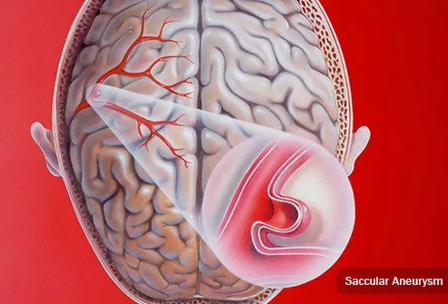 493ss medical images rm saccular aneurysm