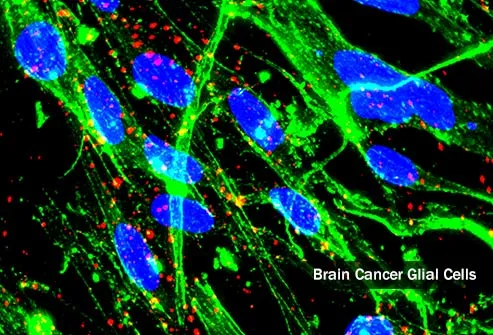 brain cancer glial cells