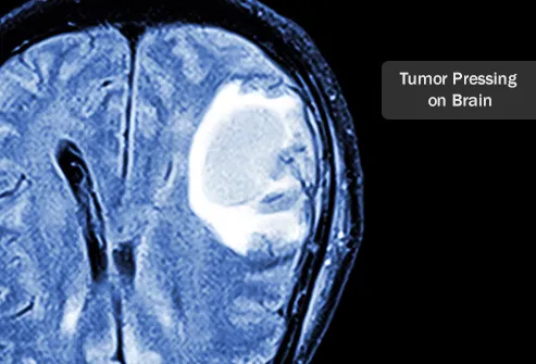Brain Tumor Size Chart Mm