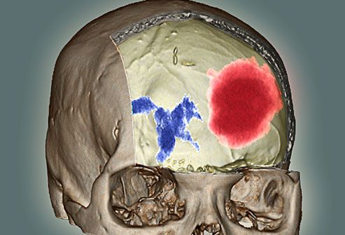 princ rm photo of 3d cat scan of brain with hematoma - ضربه به سر و مغز
