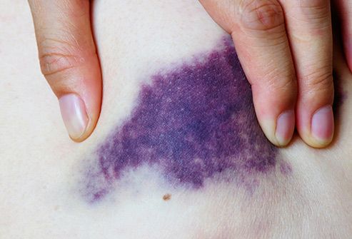 493ss_thinkstock_rf_purple_bruise.jpg