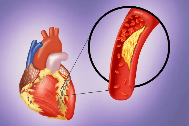 Heart Disease Link