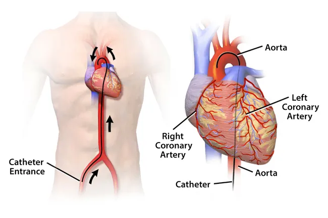illustration of cardiac catheterization