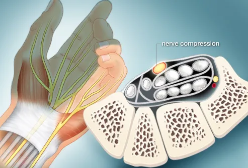 illustration of nerve compression
