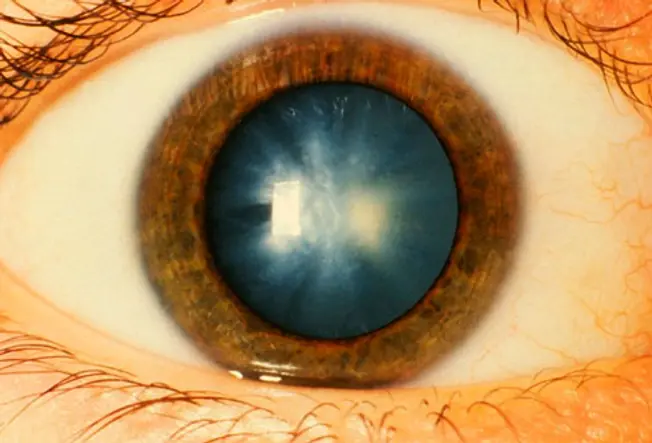What Causes Cataracts?