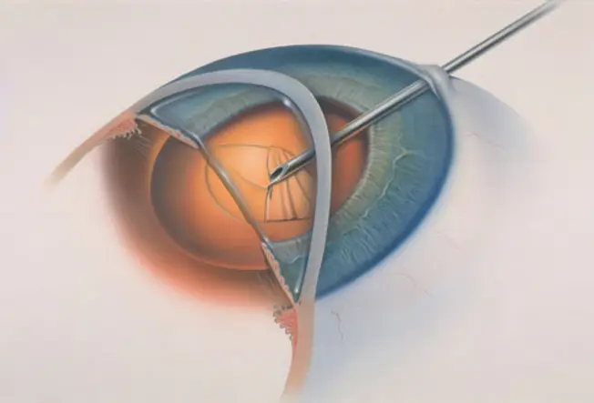 Types of Cataract Surgery