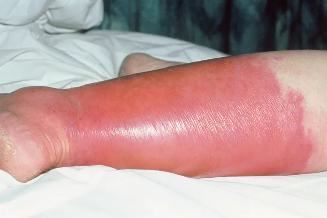 What You Need to Know About Cellulitis