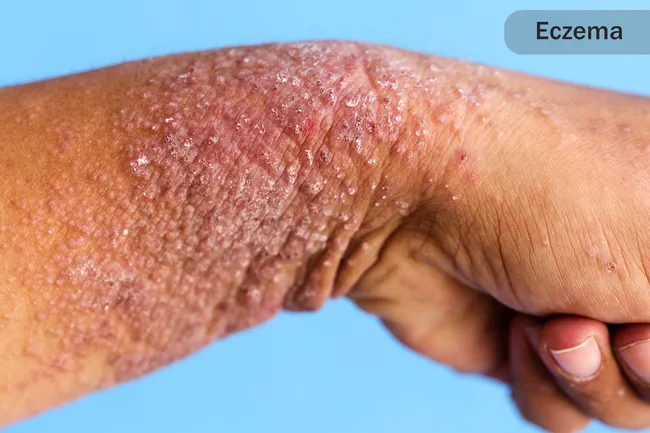 how long do shingles symptoms last after treatment