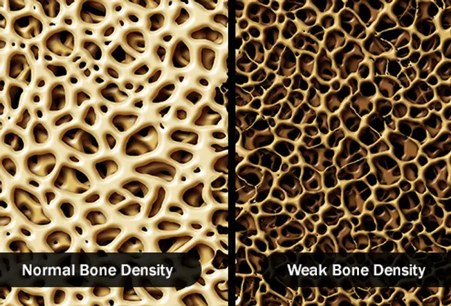 Bone Density