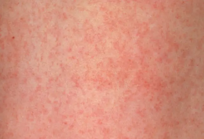 Rubella (German Measles)