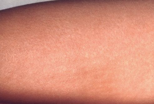 Childhood Skin Problems Slideshow Images Of Common Rashes And Skin