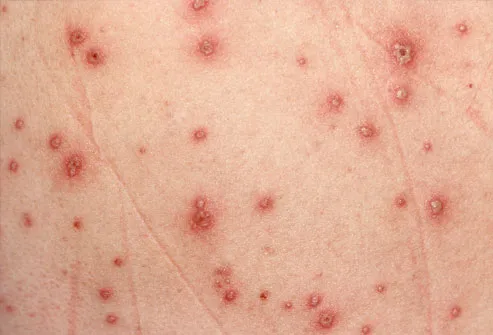 Photo of Chickenpox Skin Lesions