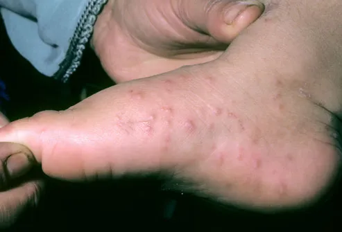 Photo of Hand-Foot-and-Mouth Disease (Coxsackie)