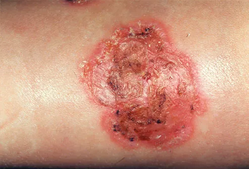 oozing red sore with crust caused by impetigo 