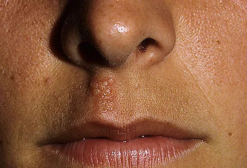 Cold Sore Pictures Causes Treatments Home Remedies And More