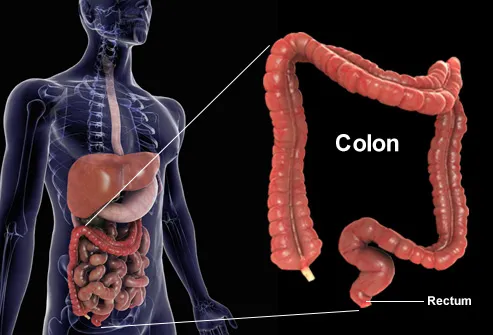 cancer de colon rectal condyloma acuminata epidemiology