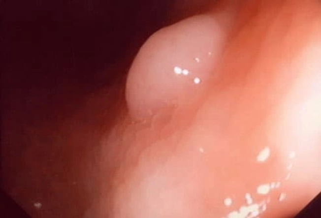 What Are Polyps?