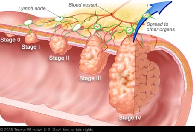 The Stages of Colorectal Cancer