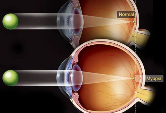 Nearsightedness: What Happens