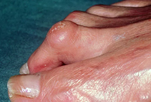 rough skin on top of big toe