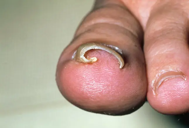 Photo of ingrown toenail on big toe