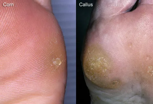 foot plantar callus