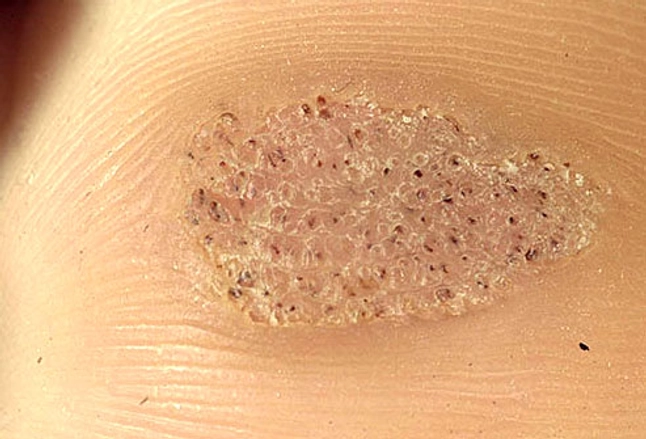 Picture of Plantar Warts
