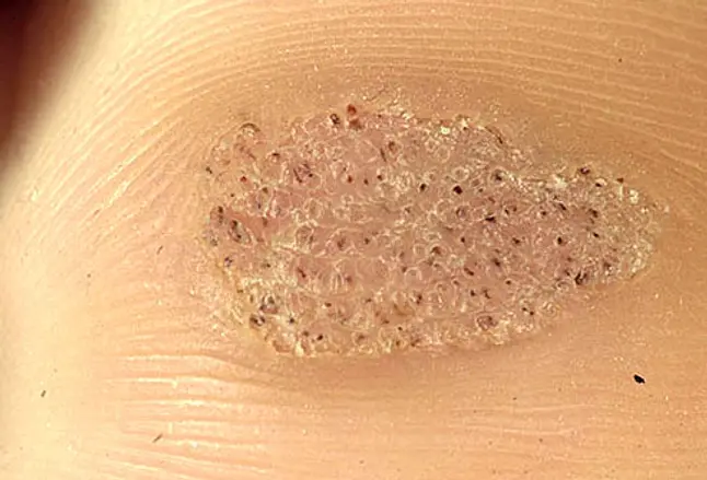 Photo close-up of plantar warts
